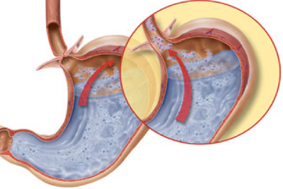 immagine del reflusso all'interno dello stomaco