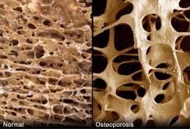 ossa sane ossa con osteoporosi